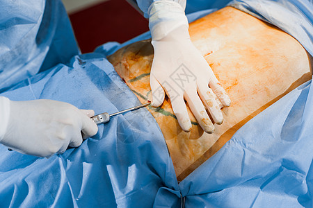 外科医生给妇女做腹部生殖器瘤 在诊所进行整形手术 在医院里 可塑性手术药品女士化妆品女性橘皮病人躯干程序治疗形术图片