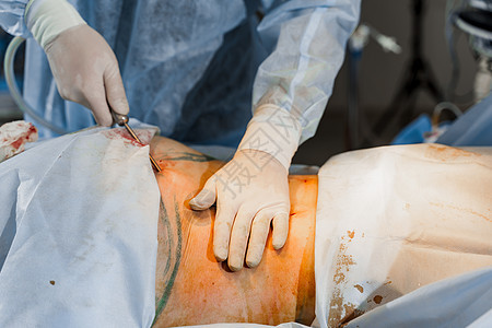 外科医生在紧闭的谷状地区除去脂肪 塑料操作 以减少腹部和去除纤维素橘皮治疗整形组织医院手术重量护士身体皮肤图片