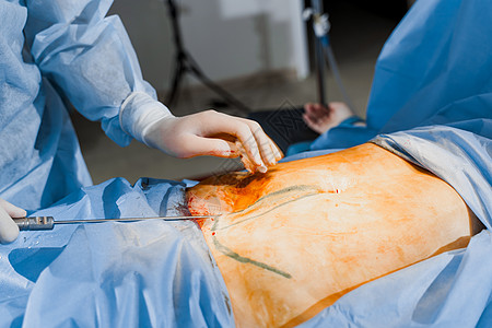 外科医生给妇女做腹部生殖器瘤 在诊所进行整形手术 在医院里 可塑性手术技术重量橘皮操作形术身体病人女性药品塑料图片
