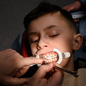 特写在牙齿上安装牙套 将牙齿与牙套对齐 嘴唇上的牵开器治疗工具高度测量矫正药品橡皮临床牙科假牙图片