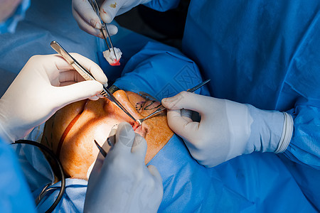 经结膜眼睑成形术 外科手术 上睑成形术 外科医生做整形手术 2 名外科医生从眼睑上取下一块皮肤治疗麻醉激光医院诊所缺陷程序化妆品图片