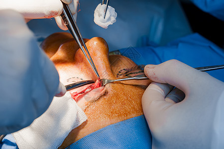 外科医生进行塑料手术 2名外科医生将皮肤从眼皮切除出来 横截面性脑膜炎眼科女士缺陷工作病人化妆品线条眼睛操作治疗图片