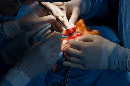 外科医生进行塑料手术 2名外科医生将皮肤从眼皮切除出来 横截面性脑膜炎工具工作老化诊所女士线条化妆品激光病人手套图片