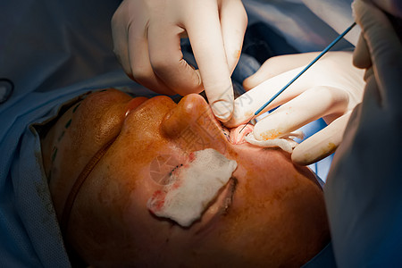 外科医生进行塑料手术 2名外科医生将皮肤从眼皮切除出来 横截面性脑膜炎工具女士美学成人诊所激光眼科缺陷老化操作图片