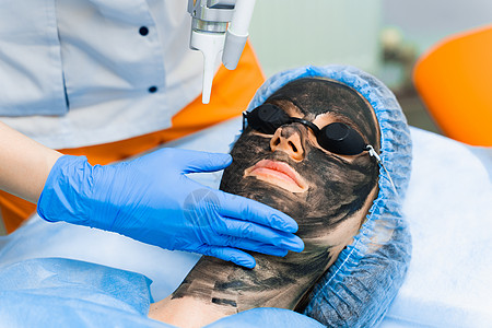 女性面部激光光子嫩肤和碳剥离 黑色面罩 皮肤科和美容科 使用手术激光病人表皮胶原黑头毛孔状况白头色素沉着剥皮电子图片