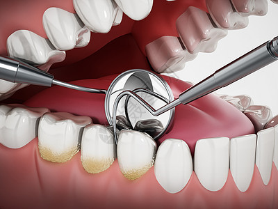3D 图例 显示牙科工具和模型上的牙科标志 3D图示图片