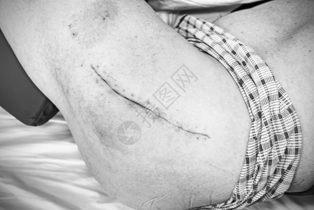 手术后一个月的病人 臀部有长长的伤疤 控制愈合 清理皮肤图片