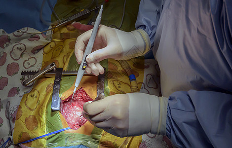 罗斯的手术是动脉阀门缺陷的外科治疗程序病人医生操作动脉瘤药品替代品助手仪器工具图片