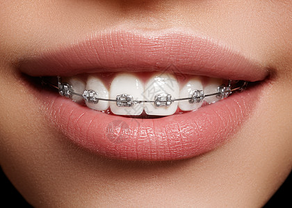 有牙套的美丽的白牙 牙科护理照片 女人微笑与矫形配饰品 整形治疗牙齿喜悦女性卫生皮肤女士宏观女孩牙医嘴唇图片