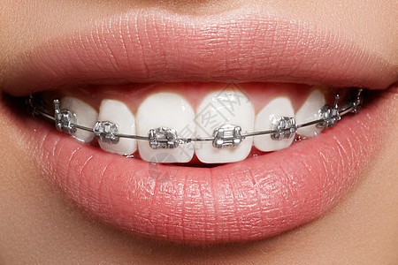 有牙套的美丽的白牙 牙科护理照片 女人微笑与矫形配饰品 整形治疗嘴唇金属幸福喜悦女士支撑女孩矫正快乐卫生图片
