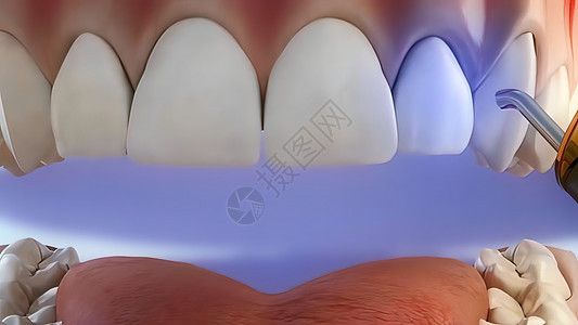切碎破坏牙齿的过程牙科诊所插图微笑笑容手术牙医牙龈聚合物服务图片
