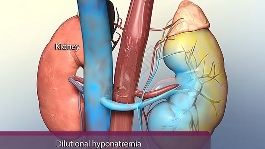 肾脏中的钠浓度低于正常血液浓度 造成中枢性贫血医院科学疾病诊断糖尿病药品失败细胞损害镜头图片