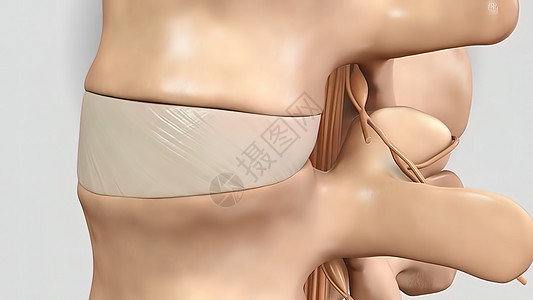 3D 销毁圆盘和压缩神经的3D示例创伤放射科卫生谐振断层脊柱科学光盘手术药品图片
