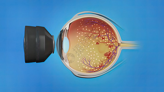 激光外科 眼激光治疗医生视网膜手术室麻醉眼镜瞳孔技术风险病人器材图片