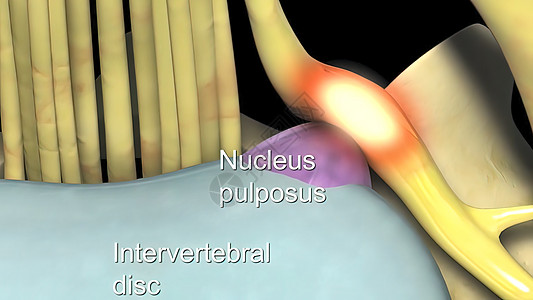 医学说明性体间脊椎盘神经突袭扫描椎间药品光盘椎骨绳索疼痛骨骼骨干身体图片