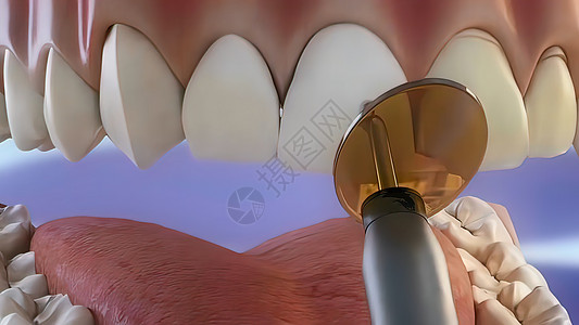 牙膏涂层工艺 用粘合光束干燥聚合物健康病人牙齿医院服务手术检查外科牙龈图片