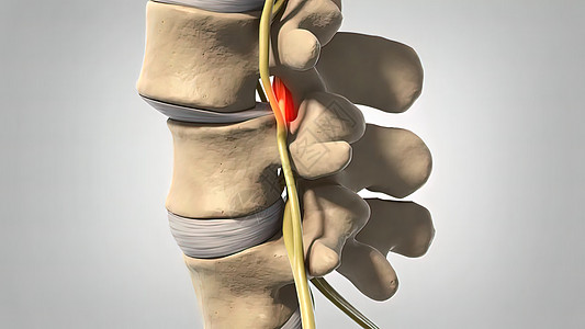 Disc 变化和神经诱捕老年卫生柱子保健状况脊椎脊柱腰椎骨头压缩图片