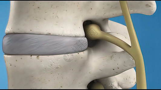 3D 销毁圆盘和压缩神经的3D示例脖子核磁共振骨科病人保健整顿放射科光盘考试电影图片