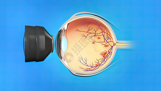 激光外科 眼激光治疗矫正眼球风险眼科药品技术眼镜疾病医生青光眼图片