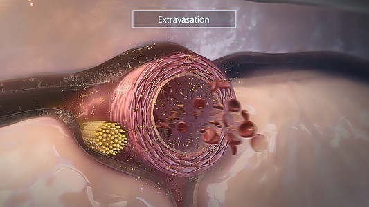 血管外溢 液体或药物从静脉渗漏到周围组织 注 表2分裂癌细胞生活细菌免疫免疫系统治疗疾病宏观细胞图片