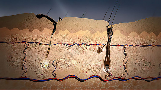 皮肤发炎和肿胀皮脂腺组织地层颜料疼痛肌肉器官症状静脉癌症图片