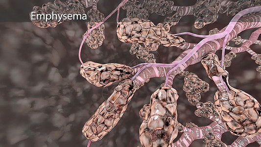 Emphiema是一种肺部疾病 造成呼吸短促插图生理身体气肿生物学肺泡疼痛支气管炎器官图表图片
