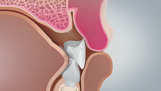 如果口香糖消退太多 可能导致骨折 导致牙齿松散或脱落宏观疾病插图细菌石头诊所治疗卫生牙龈假牙图片