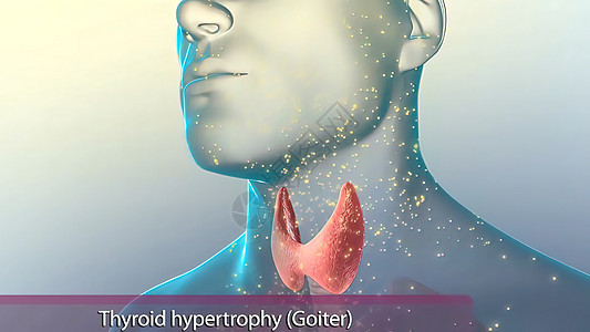 甲状腺生成的甲状腺荷尔蒙 超过你身体需要的水平时 超正态就成为了激素生物学图表3d解剖学腹部器官癌症脖子甲亢图片
