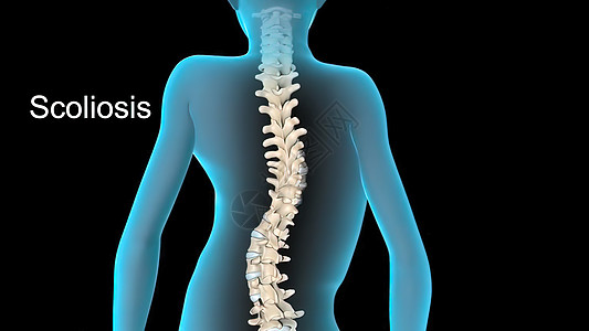 脊椎结裂解剖 姿势校正 慢性病治疗 后退止痛图片