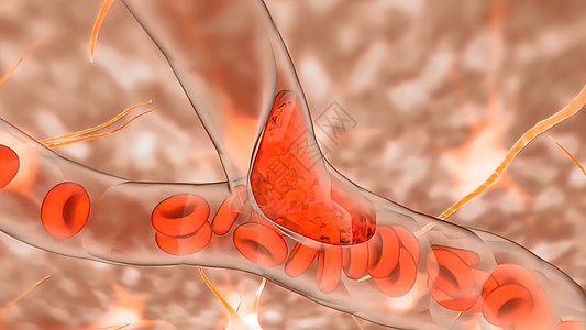 组织对缺化学反应贫血侮辱高压血栓临床细胞空气实验室压力中风图片