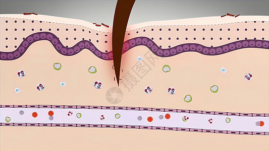 细菌 创伤 毒素 热或其他任何原因导致的炎症 组织损伤皮肤细胞因子细胞淋巴树突图表药品疾病免疫学皮炎图片