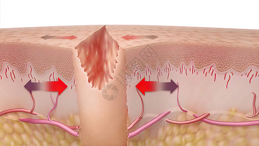 皮肤细胞3D 皮肤伤口愈合时间的医疗说明胶原改造组织静脉血管皮肤科真皮润肤图层制粒背景