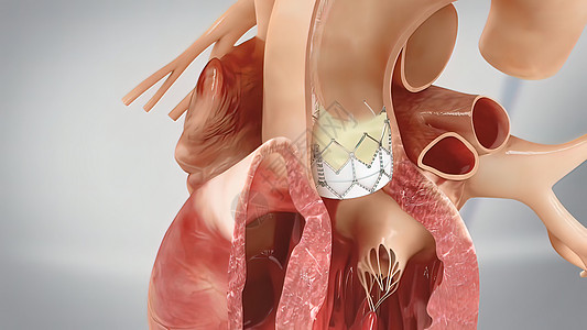 冠心血管成形术和刺塞插入形术气球治疗支架血管牌匾教育动脉心脏程序图片