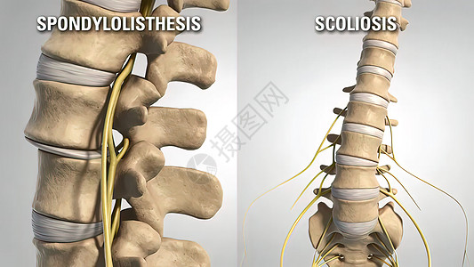 脊柱模型Lumbar 退化性疾病骶椎运动解剖学艺术品小路辉光女士风湿病椎骨背痛背景