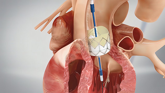 冠心血管成形术和刺塞插入导管导尿疾病科学心脏手术药物封锁牌匾干涉图片
