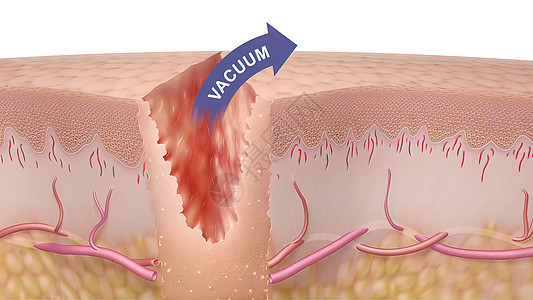 3D 皮肤伤口愈合时间的医疗说明静脉动脉间质纤维改造润肤康复细胞科学表皮图片