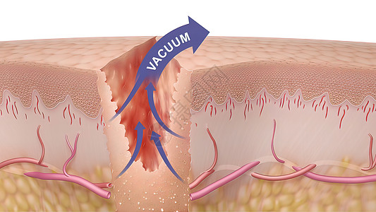 皮肤细胞3D 皮肤伤口愈合时间的医疗说明动脉真皮纤维血管疾病静脉科学间质血肿图层背景