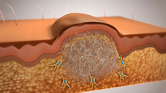皮肤伤口愈合解剖学疾病胶原血肿纤维制粒图层润肤康复细胞图片