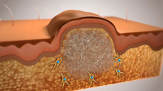 皮肤伤口愈合间质改造血肿动脉细胞纤维疾病插图静脉图表图片