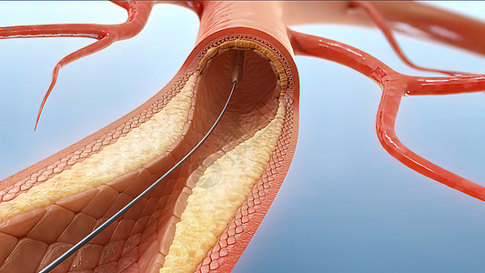血管成形和血管压力手术攻击插图模拟疾病心脏病学静脉支架封锁图片