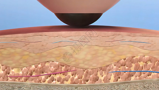 激光皮肤再造外科3D医疗图片