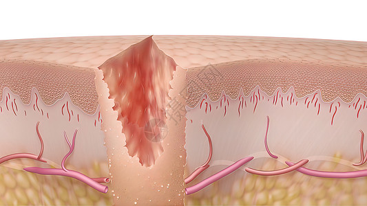 皮肤细胞3D 皮肤伤口愈合时间的医疗说明真皮细胞康复科学插图疾病改造皮肤科血管表皮背景