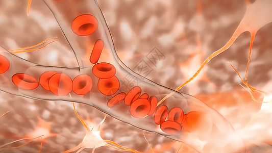 白血病是一种由死白血组成的脂肪物质 其内含异性瘤细胞肥胖心血管科学中风计算机动脉粥样硬化动画静脉循环图片