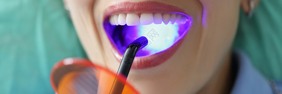 口口开口接受牙医预约的妇女尝试白化程序图片