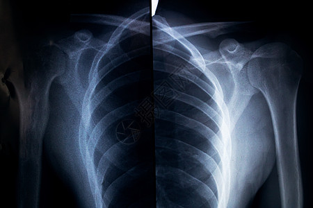 从两侧对肩部进行X射线检查图片