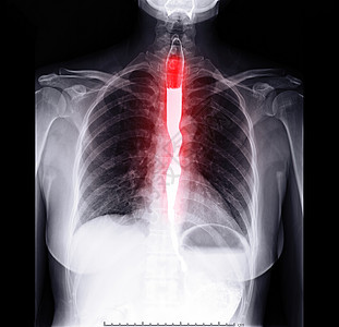 食管气体疾病胃体医院小肠胃肠道大衣消化道放射科癌症图片
