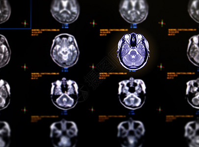 MRI 脑轴视图选择性焦点图片