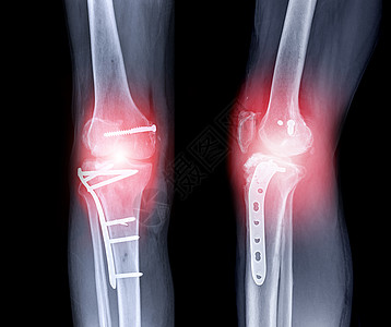 右膝的X光图像髌骨大腿外科疼痛老年药品扫描鞭策医院考试图片