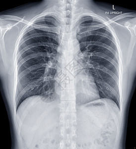 人类胸前X光或X光图像图片