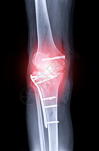 右膝的X光图像扫描电影高原成形术手术骨骼盘子医生外科大腿图片